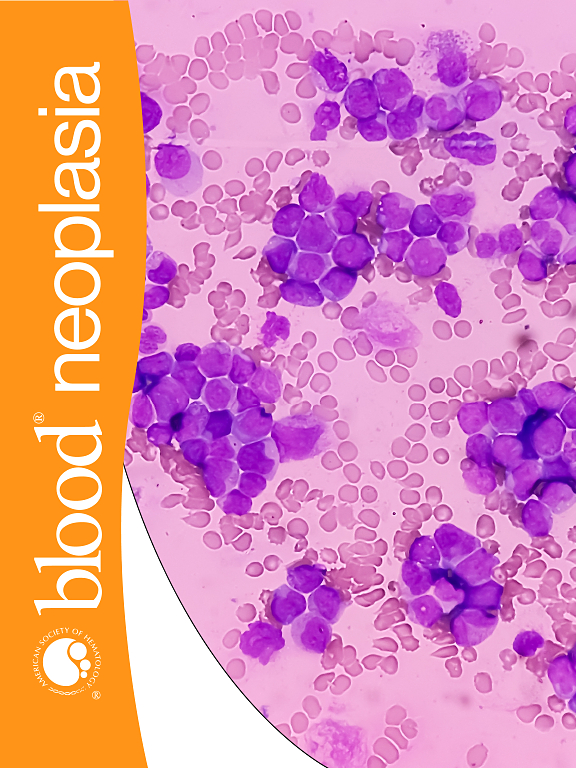 Go to journal home page - Blood Neoplasia